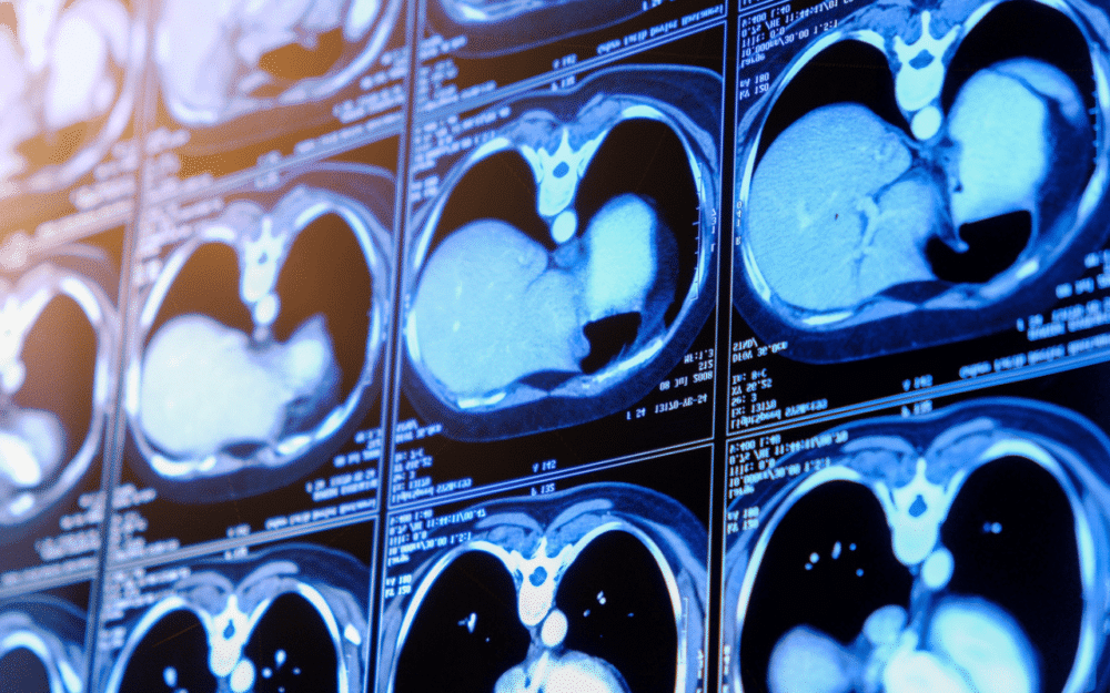 [Summer Rewind] Federated Learning: Training AI Models Without Sending Data