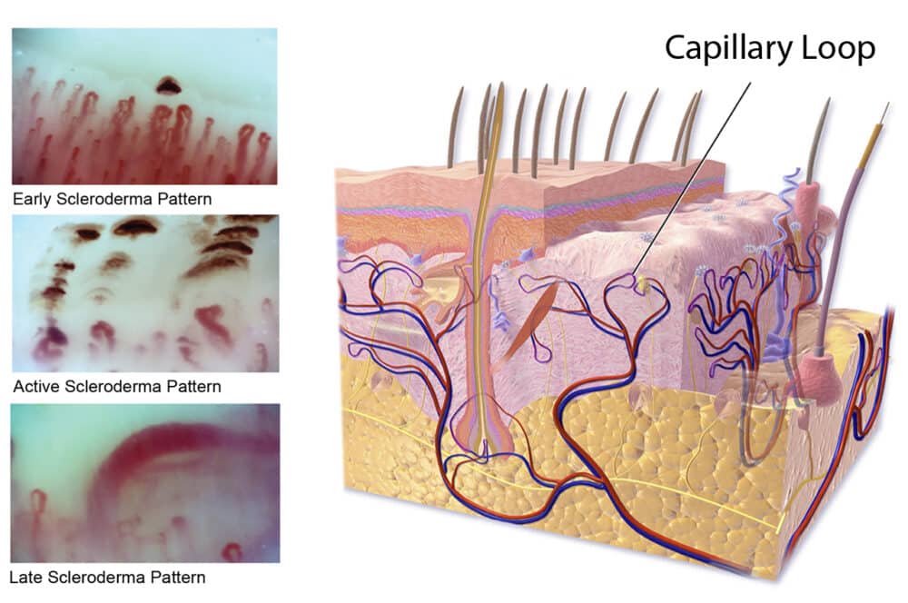 Inspectis Expand Possibilities of Capillaroscopy Examination