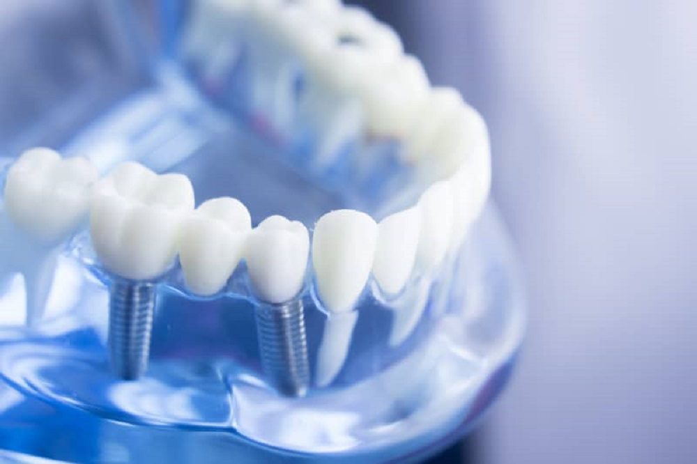 IDS: Smart Dental Implants to Revolutionize Oral Health 
