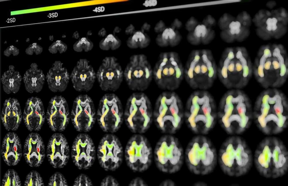 Report. Courtesy of BrainTale.