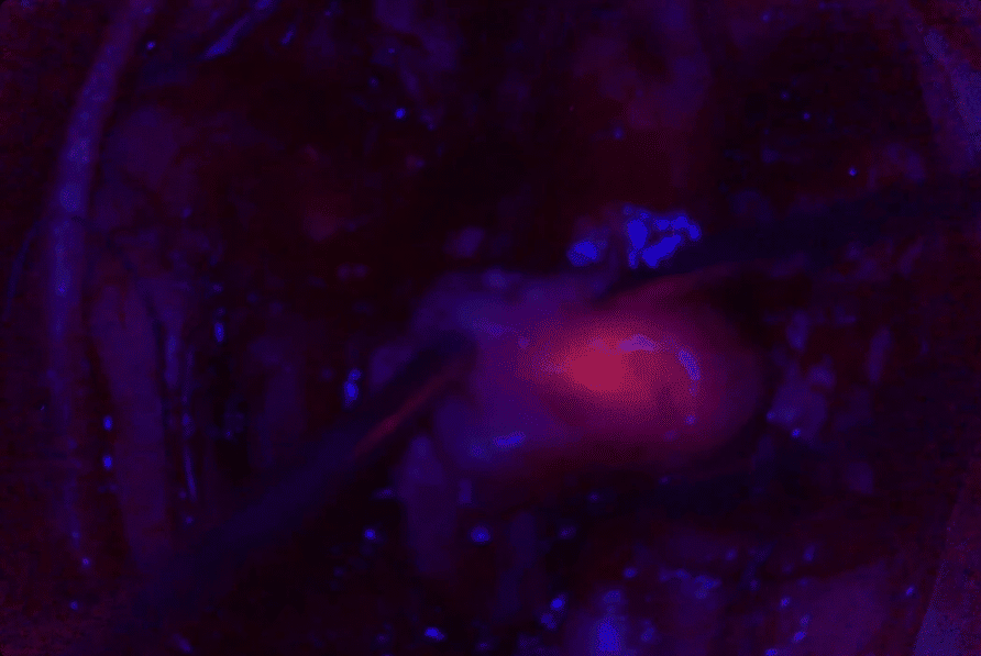 Tumor resection using 5-ALA during a surgical procedure. (Image: Courtesy of Dr Carla Reizinho)