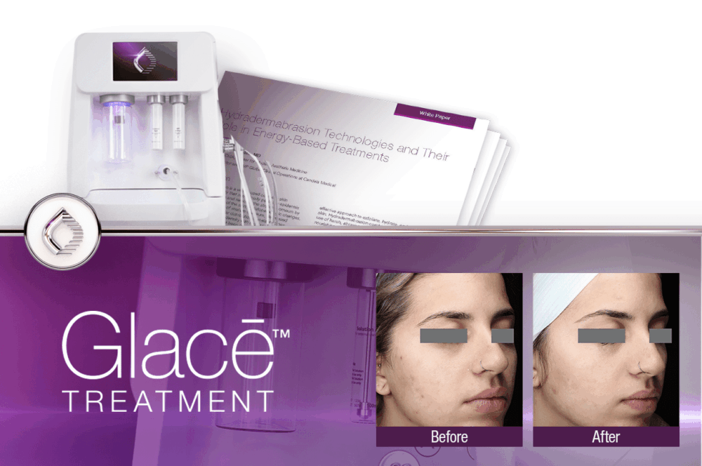 Glacē™ Treatment - Hydrodermabrasion, Cupping Massage, and LED Technology