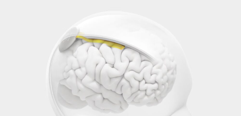 Courtesy of Precision Neuro