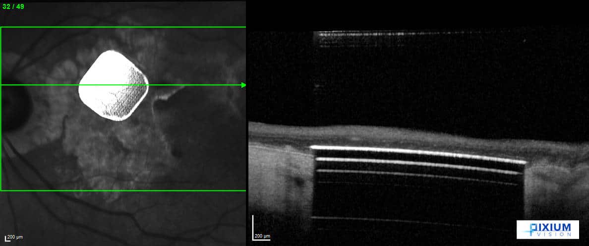 The Prima device - OCT (Credit: Pixium Vision)