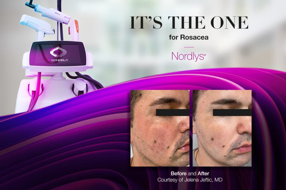 sponsored-article-1280x850-integrated-2-erythemotelangiectatic-rosacea-treatment-with-nordlys-vl555-and-pr530-1000x664-1