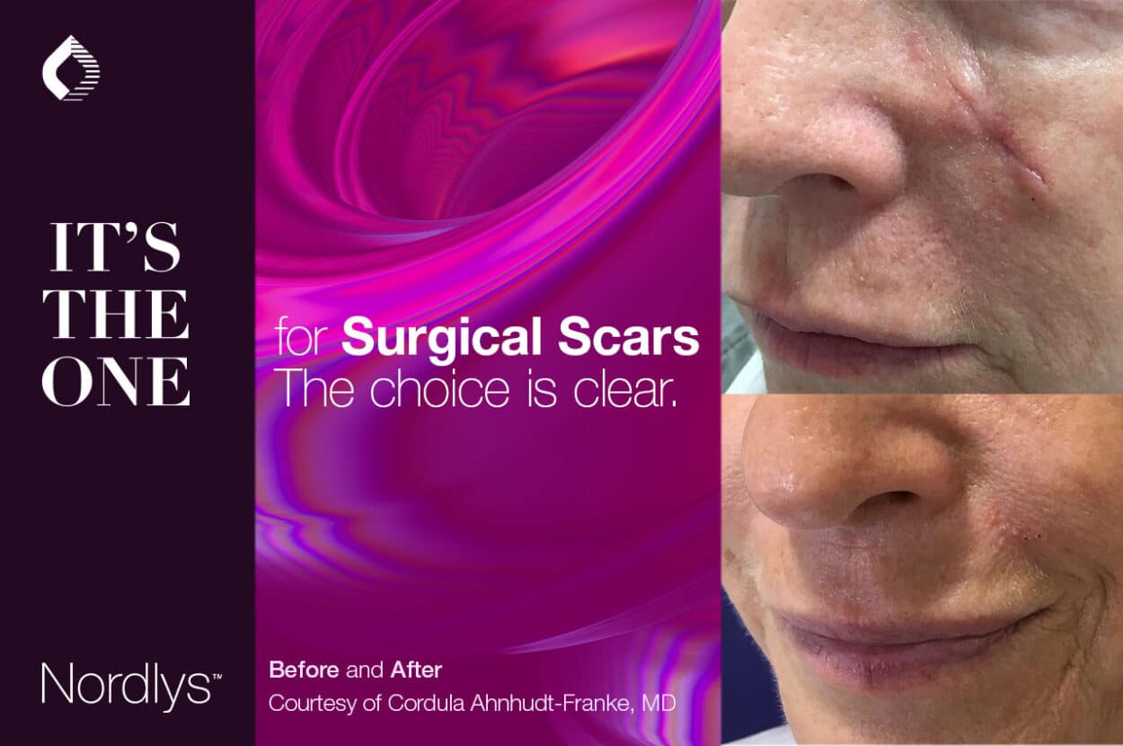 Surgical scars treatment with Frax 1550. (Credit: Candela)