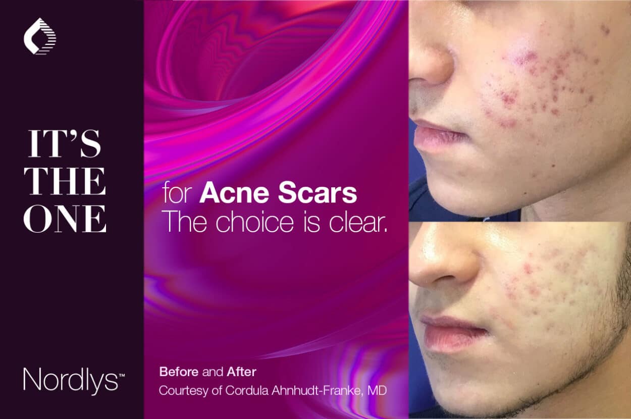 Acne scars treatment with SWT PR 530 handpiece. (Credit: Candela)