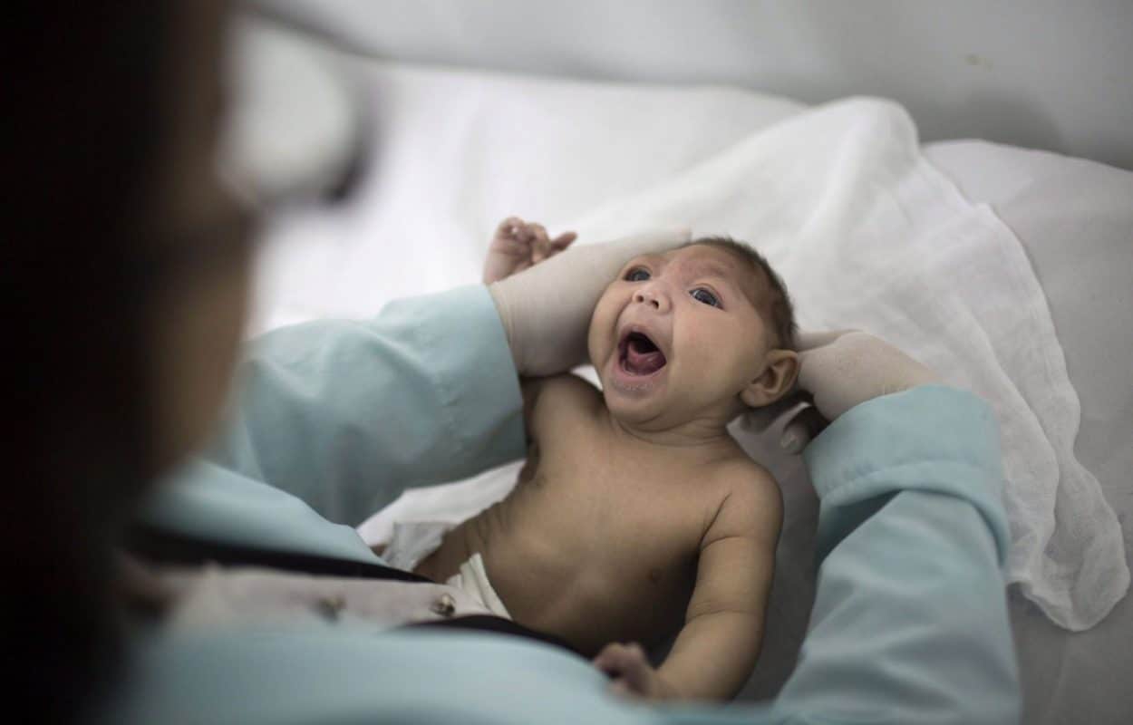 Zika virus infection during pregnancy is a cause of microcephaly. (Credit: Felipe Dana Associated Press)